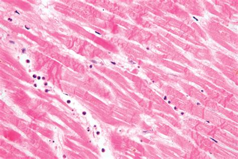 Myocardial Infarction Pathology Britannica