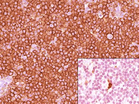 Ocular Adnexal Marginal Zone Lymphoma Oamzl