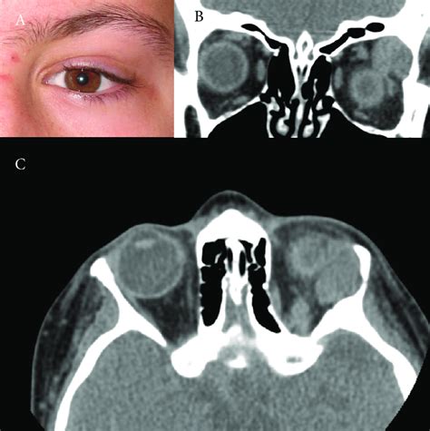 Young Patient With Left Lacrimal Gland Pleomorphic Adenoma A Coronal