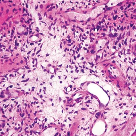 Phosphaturic Mesenchymal Tumor Nodule Comprised Of Spindle Cells