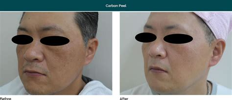 Carbon Laser Peel - Cliffside Skin & Laser | Cliffside, NJ