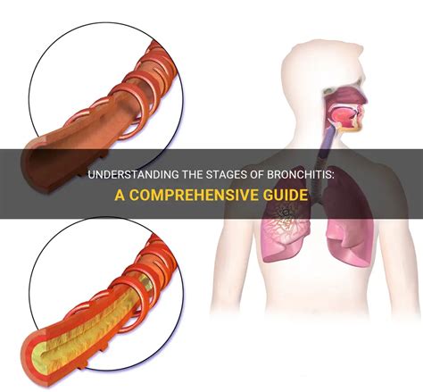 Understanding The Stages Of Bronchitis: A Comprehensive Guide | MedShun