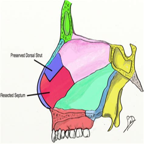 Evolution Of The Septoplasty Maximizing Functional And Aesthetic