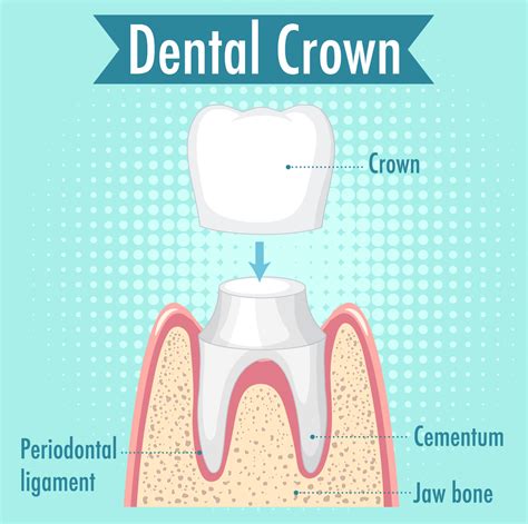 Comparing Types Of Dental Crowns | Dr. McVey | Read