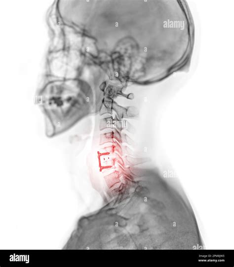 X Ray C Spine Or X Ray Image Of Cervical Spine Lateral View Showing