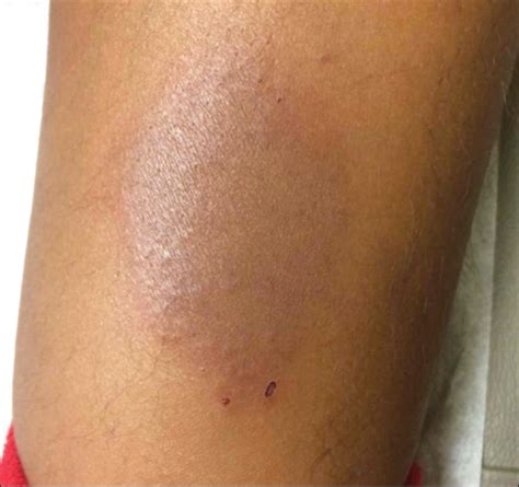 Red-Brown Plaque on the Leg | MDedge Dermatology