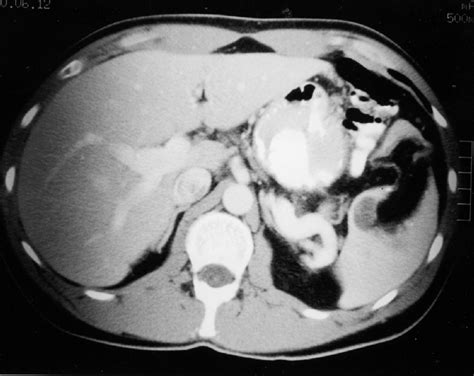 Ct Scan Showing Large Splenic Cyst Figure 2 Ct Scan 6 Months Download Scientific Diagram