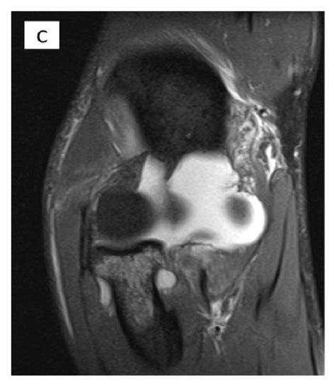 A Isolated Rupture Of The Anterior Medial Ulnar Collateral Ligament Download Scientific