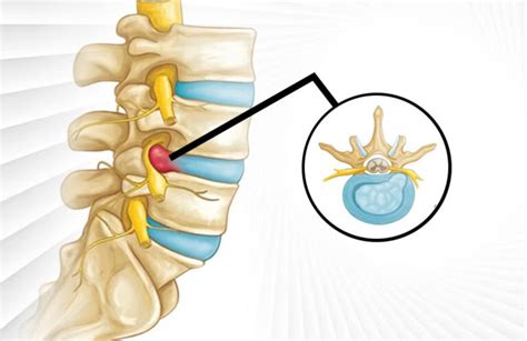 Can A Herniated Disc Recover Naturally Aspc Manipulation Therapy