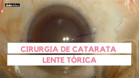 V Deo De Cirurgia De Catarata Implanta O De Lente Intraocular