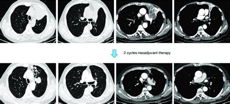 Ct Scan Of The Patient Before And After Neoadjuvant Therapy Showed The Download Scientific