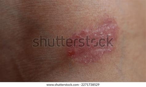 Psoriasis Skin Disease Causes Rash Itchy Stock Photo 2271738529 ...