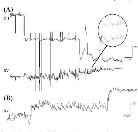 Figure 1 From Upbeat Nystagmus Changes To Downbeat Nystagmus With