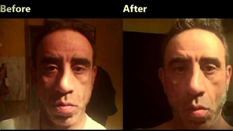 Face Exercise Before And After Pictures 10 26 15 Youtube