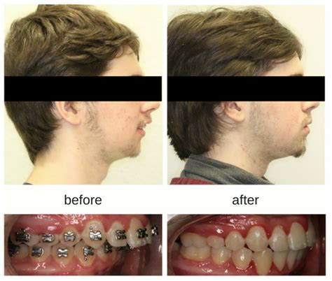 Braces Before And After Overjet