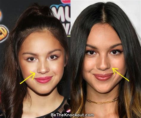 Olivia Rodrigo Plastic Surgery Comparison Photos