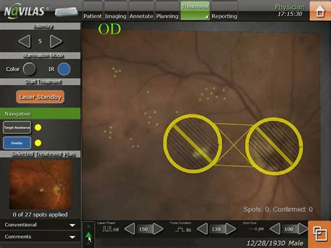 Figure From Pain And Accuracy Of Focal Laser Treatment For Diabetic