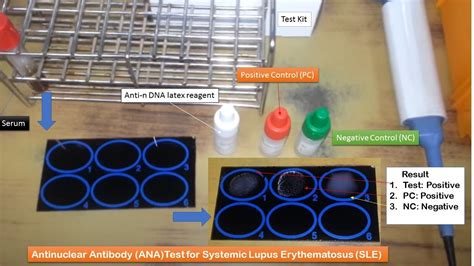 Systemic Lupus Erythematosus Or Sle Latex Testantinuclear Antibodies