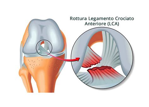 Lesione Al Legamento Crociato Anteriore In Cosa Consiste Puro Benessere