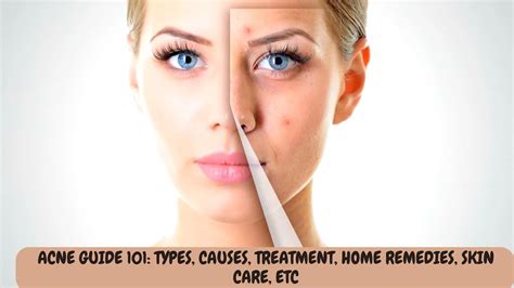 Acne Guide 101 Types Causes Treatment Home Remedies Skin Care