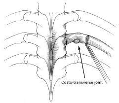 Thoracic Costo-Transverse Joint Pain (posterior rib pain)