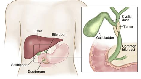 Bile Duct Cancer Homeopathy Treatment Lucknow, Mumbai & Delhi, India ...