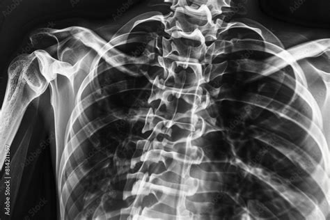 Chest X-Ray Image Showing Human Ribs Stock Photo | Adobe Stock