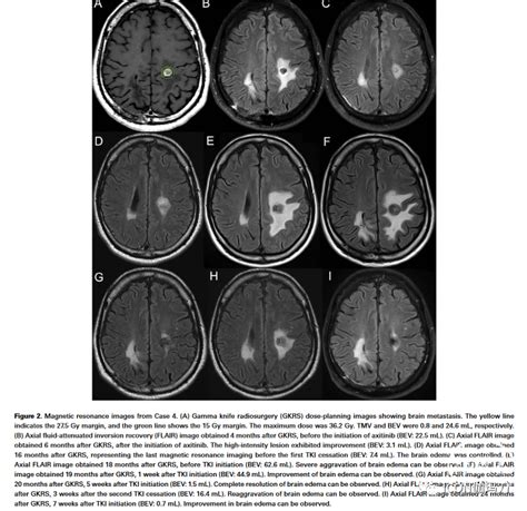 【文献快递】vegfr Tki治疗伽玛刀放射外科肾细胞癌脑转移后放射性脑损伤 脑医汇 神外资讯 神介资讯