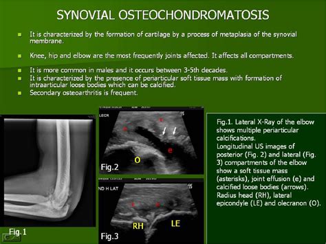 Figure From Ultrasound Of The Elbow What The Radiologist Should