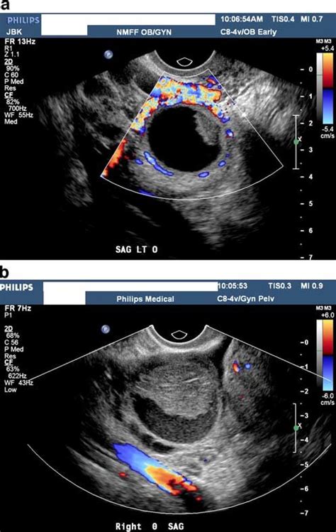 Corpus Luteum Cyst Histology