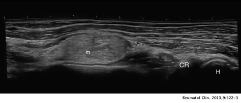 Lipoma Forearm