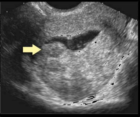 Uterine Pathology Images Flashcards | Quizlet