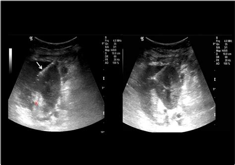 Complications Of Liver Biopsy Intechopen