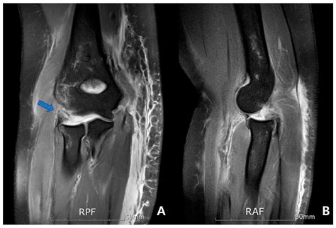 Medial Collateral Ligament Elbow Mri