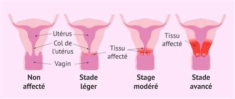 Hpv Symptomes Chez La Femme Sale Pacificproductsandservices