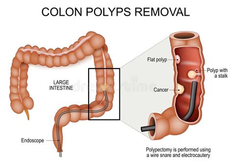 Colon Polyps Removal. Colonoscopy and Polypectomy Stock Vector ...