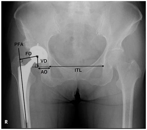 Jcm Free Full Text Clinical Outcomes For Total Hip Arthroplasty