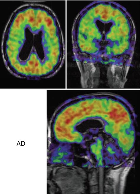 PET Tracers For Beta Amyloid And Other Proteinopathies Radiology Key