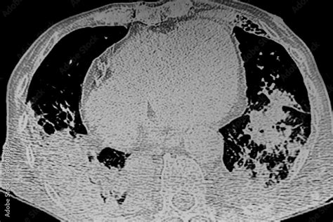 X- ray image showing bilateral pneumonia. Medical themes Stock Photo | Adobe Stock