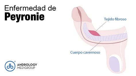 SÍntomas De La Enfermedad De Peyronie Dr Thanos Pallantzas