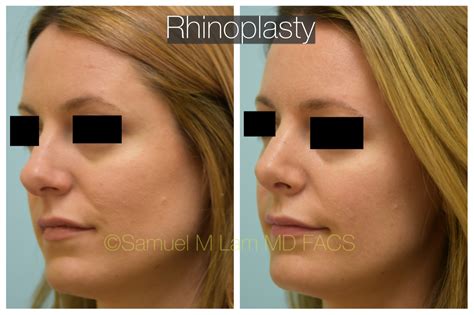 Rhinoplasty Rhinoplasty Facial Plastic Surgery Facial Plastic