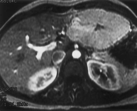 Hepatic Adenomas Imaging And Pathologic Findings Radiographics