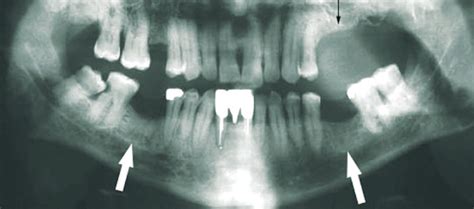 Bifosfonatos Y Osteonecrosis Mandibular Salud Ediciones