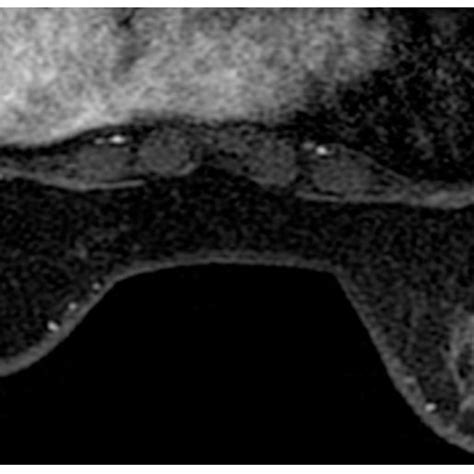 A 44 Year Old Woman In The Inflammatory Breast Diseases Group A