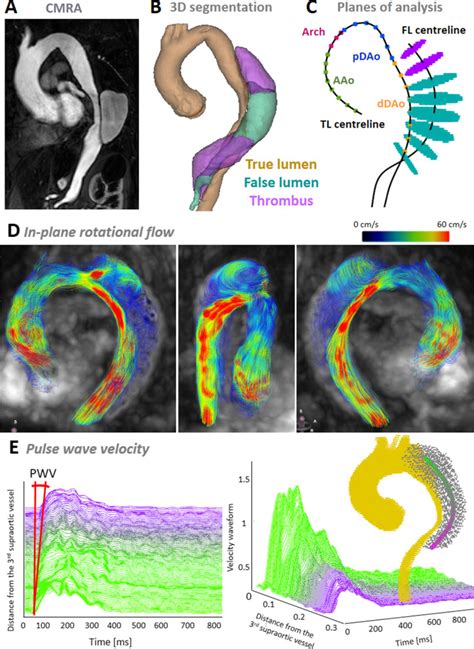 False Lumen Rotational Flow And Aortic Stiffness Are Associated With