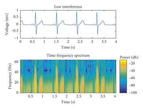 The Time Frequency Spectrum For Five Types Of Dynamic Ecg Signals