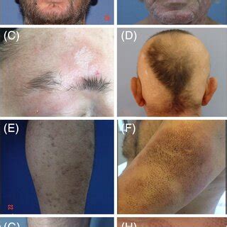 Clinical Spectrum Of Folliculotropic Mycosis Fungoides Lesions A