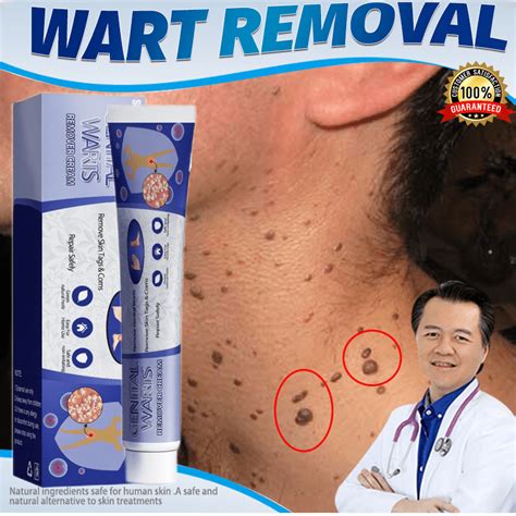 Warts Removal Cream Ubat Buang Kutil Ketuat Tahi Lalat Biji Kolestrol