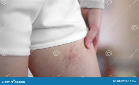 A Woman Was Bitten By An Insect On The Leg Close Up Consequences Of