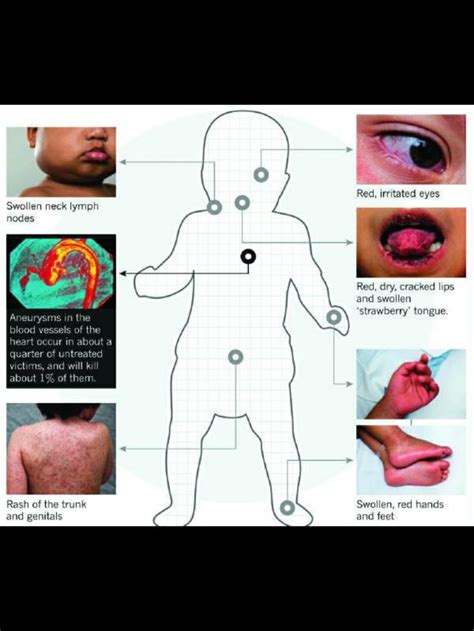 Kawasaki Disease Kawasaki Disease Pediatric Nursing Nursing Study